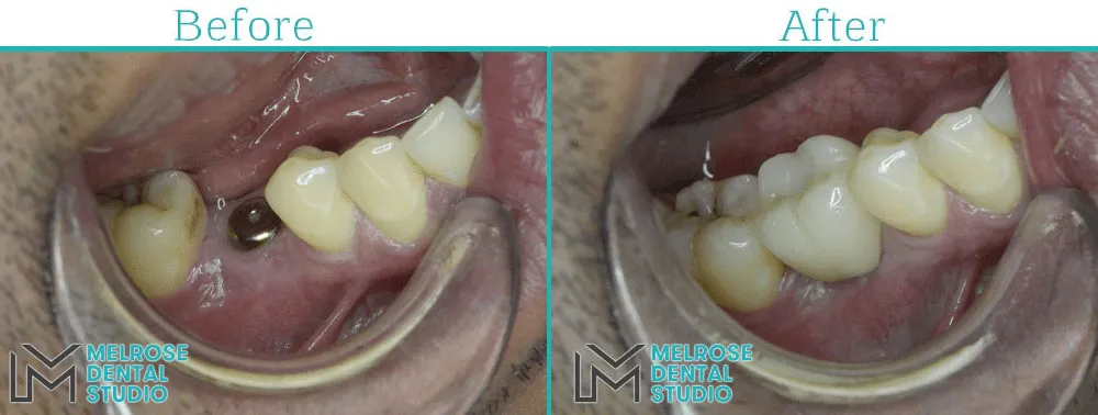 Before and after of a smile restored with Nobel Biocare dental implants, case 5
